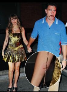 Fans have recently spotted Taylor Swift’s noticeable burn injury in photos taken with Travis Kelce.....Full details below 