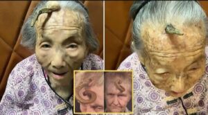 “This is too risky”: 107YO went viral because the 4-inch “Longevity Horn” growing on her forehead was said to be due to… see more