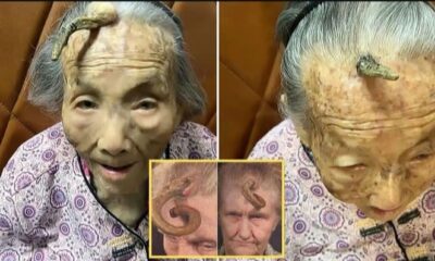 “This is too risky”: 107YO went viral because the 4-inch “Longevity Horn” growing on her forehead was said to be due to… see more