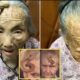 “This is too risky”: 107YO went viral because the 4-inch “Longevity Horn” growing on her forehead was said to be due to… see more